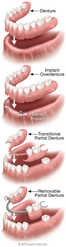 Types of Full Dentures