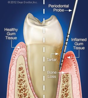 Periodental Therapy in Jacksonville, Tx