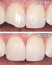 tooth bonding before and after
