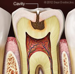 Dental Fillings By a Dentist In Jacksonville, Texas, to cure cavity
