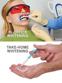 Teeth Whitening option in Jacksonville, Tx