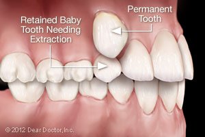 tooth extractions in garland tx