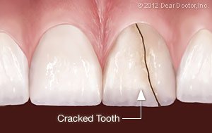 Crackeed Tooth Dentist in Jacksonville, Texas