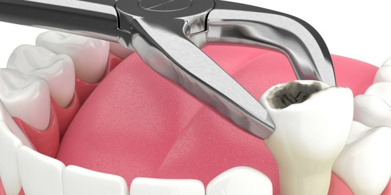 Do’s And Dont’s Post Tooth Extraction
