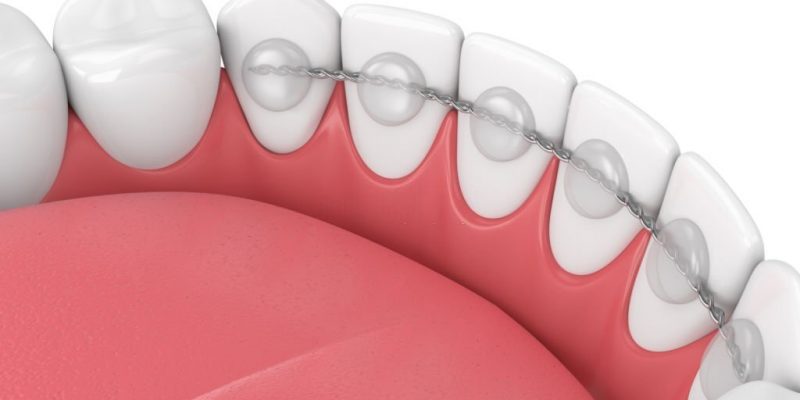 What Makes Dental Bonding A Reliable Option For Your Brighter Smile