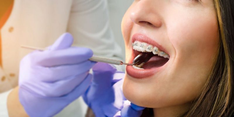 Different Types Of Orthodontic Treatments orthodontist in Garland tx
