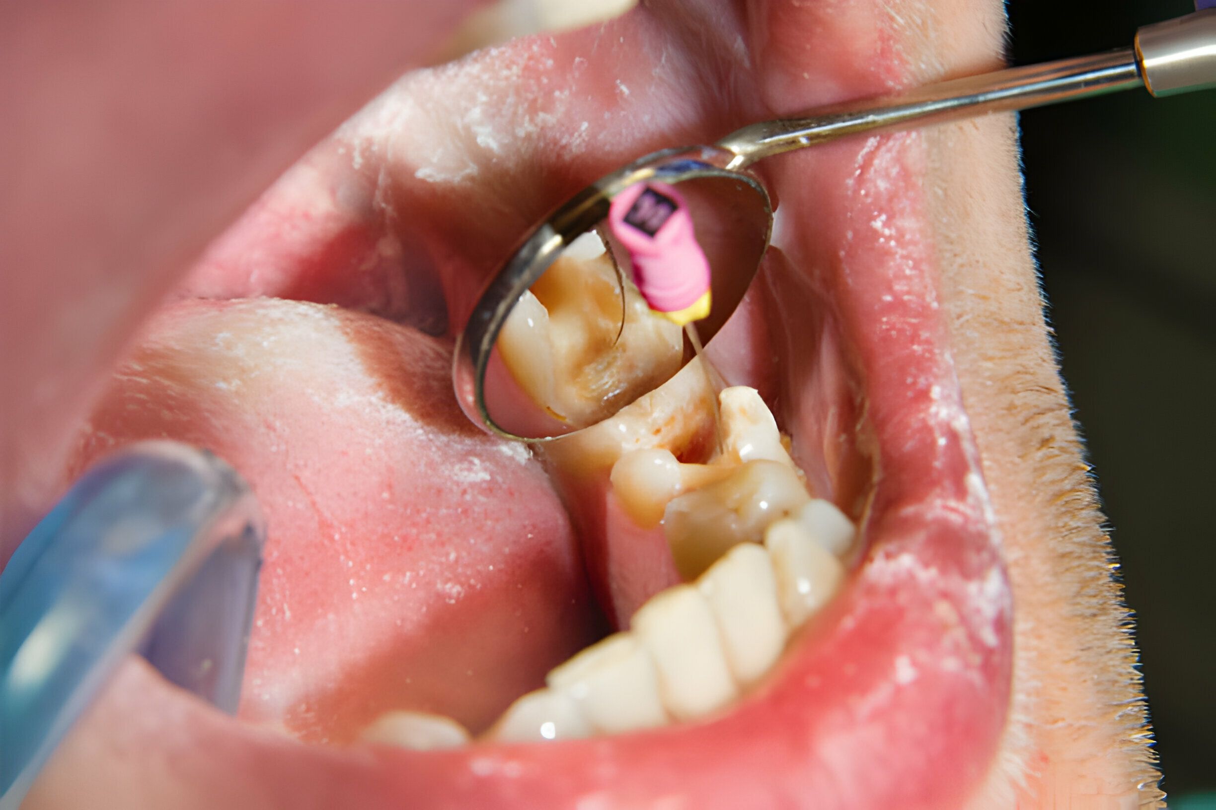 Understanding Root Canals: How They Work and Why They Save Teeth_3