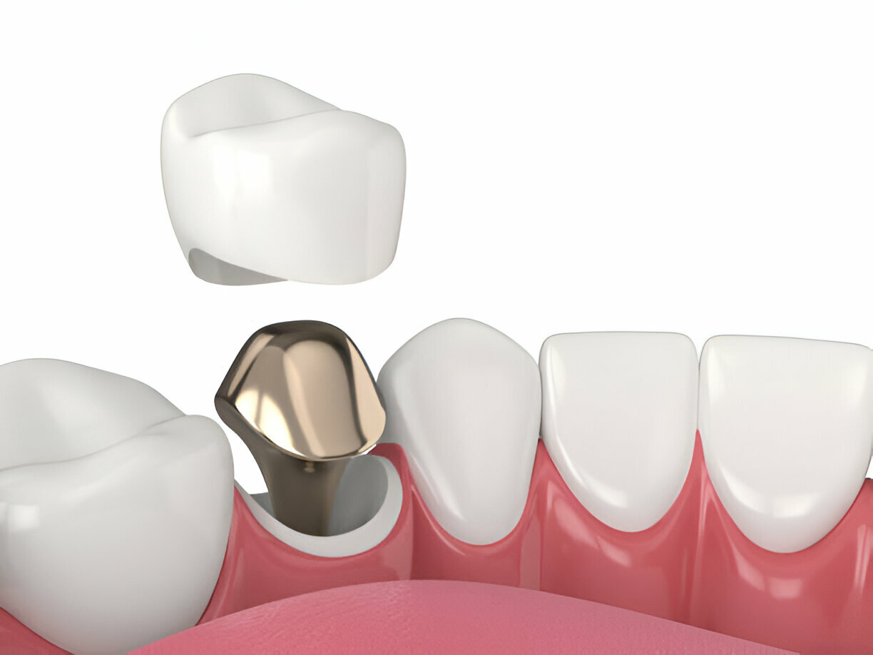 Maintaining Your Porcelain Veneers: Tips for Longevity and Durability_1