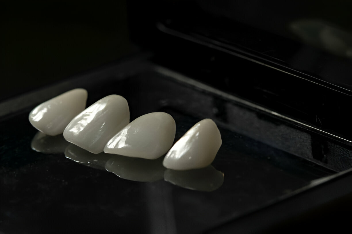 Maintaining Your Porcelain Veneers: Tips for Longevity and Durability_3