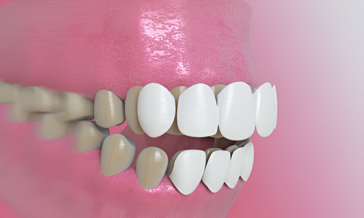 Maintaining Your Porcelain Veneers: Tips for Longevity and Durability_2