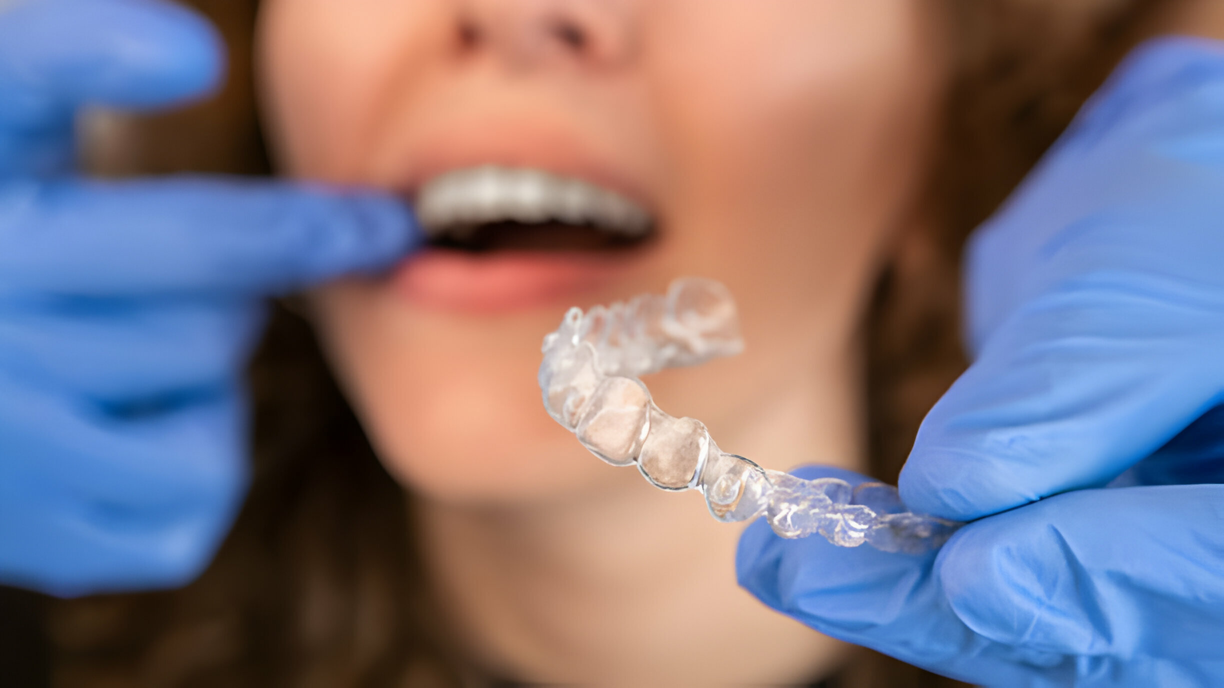 Transform Your Smile with Invisalign: A Step-by-Step Journey to Straighter Teeth_1