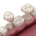 How to Choose the Best Dental Crown for Your Needs_FI