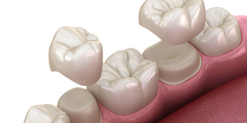 How to Choose the Best Dental Crown for Your Needs_FI