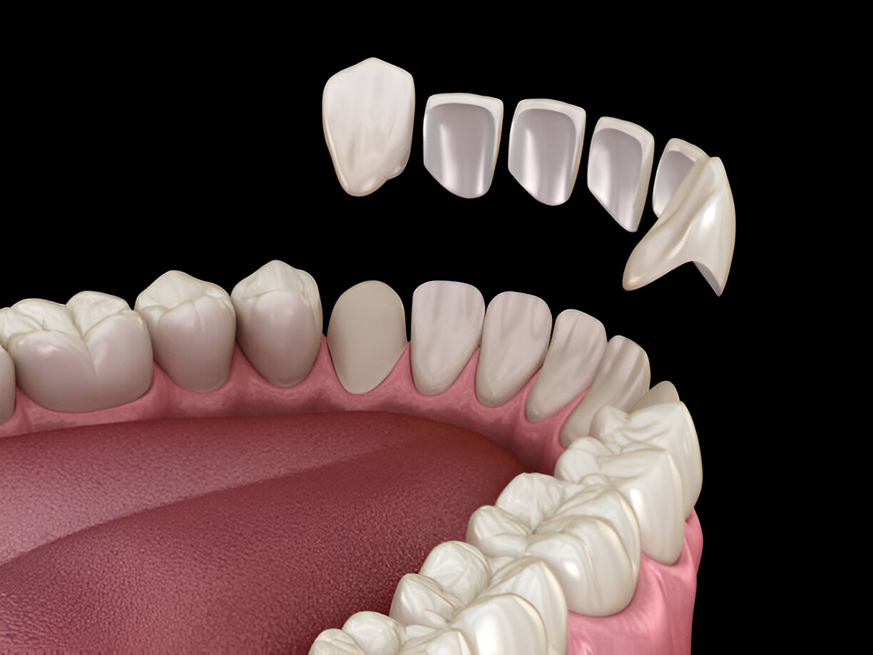 Cherokee Family Dental: Transform Your Smile with Porcelain Veneers in Jacksonville, TX_2