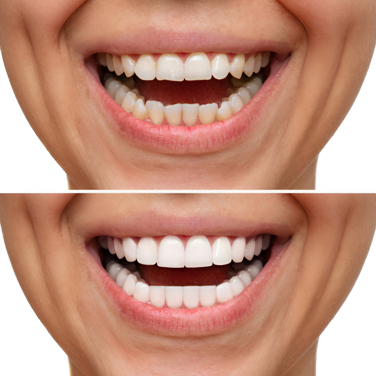 Cherokee Family Dental: Transform Your Smile with Porcelain Veneers in Jacksonville, TX_3