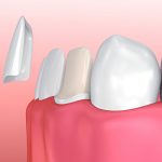 Cherokee Family Dental: Transform Your Smile with Porcelain Veneers in Jacksonville, TX_FI