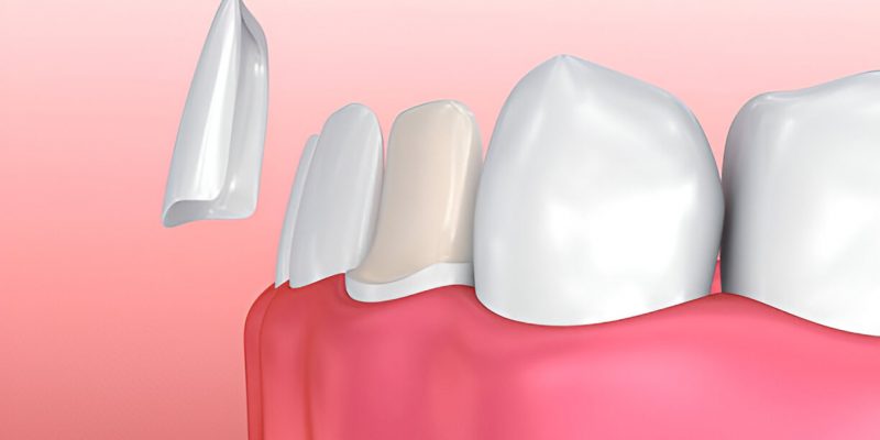 Cherokee Family Dental: Transform Your Smile with Porcelain Veneers in Jacksonville, TX_FI