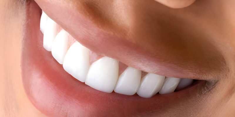 From Stained to Stunning: Teeth Whitening Results at Cherokee Dental Professionals_FI